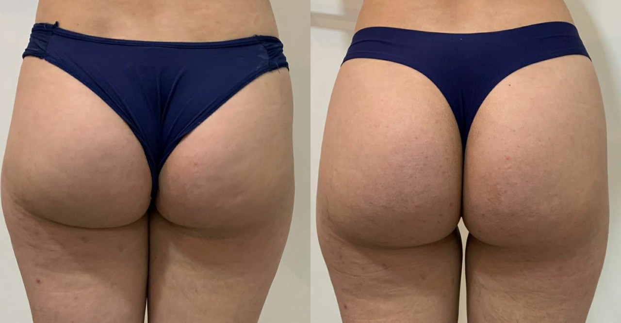 Antes e depois com melhora da firmeza, contorno e textura da região glútea