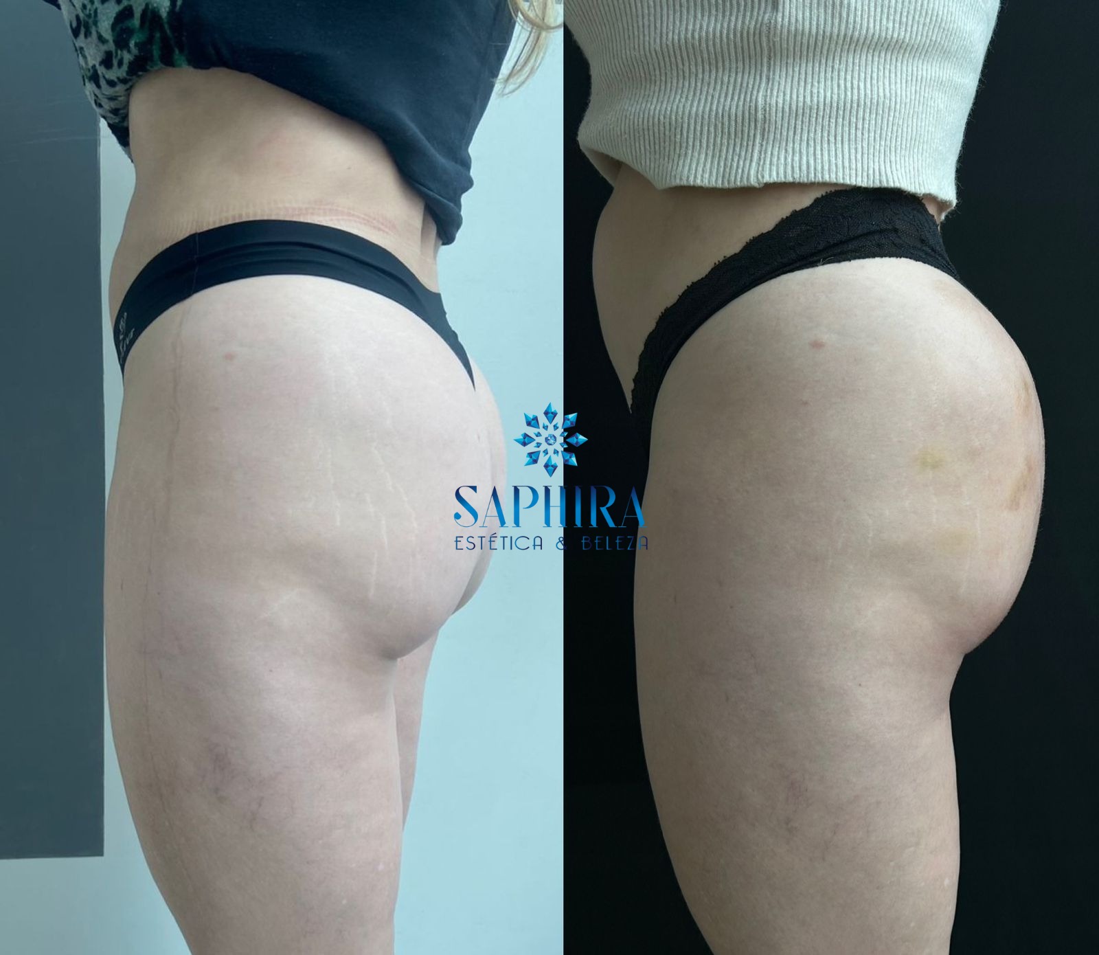 Antes e depois com melhora da projeção e sustentação glútea