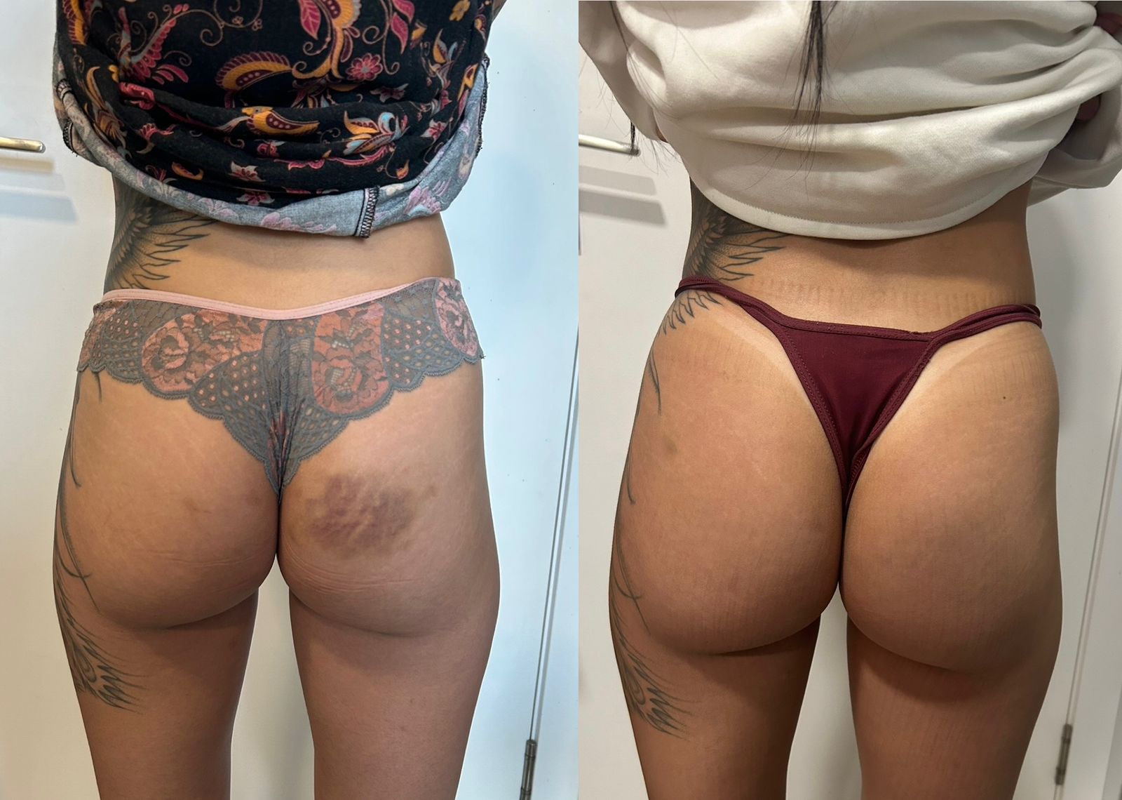 Antes e depois com aumento de projeção e melhora do contorno glúteo