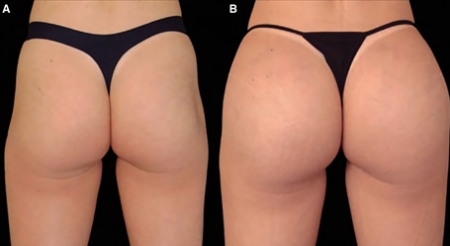 Antes e depois com mais volume, arredondamento e contorno glúteo